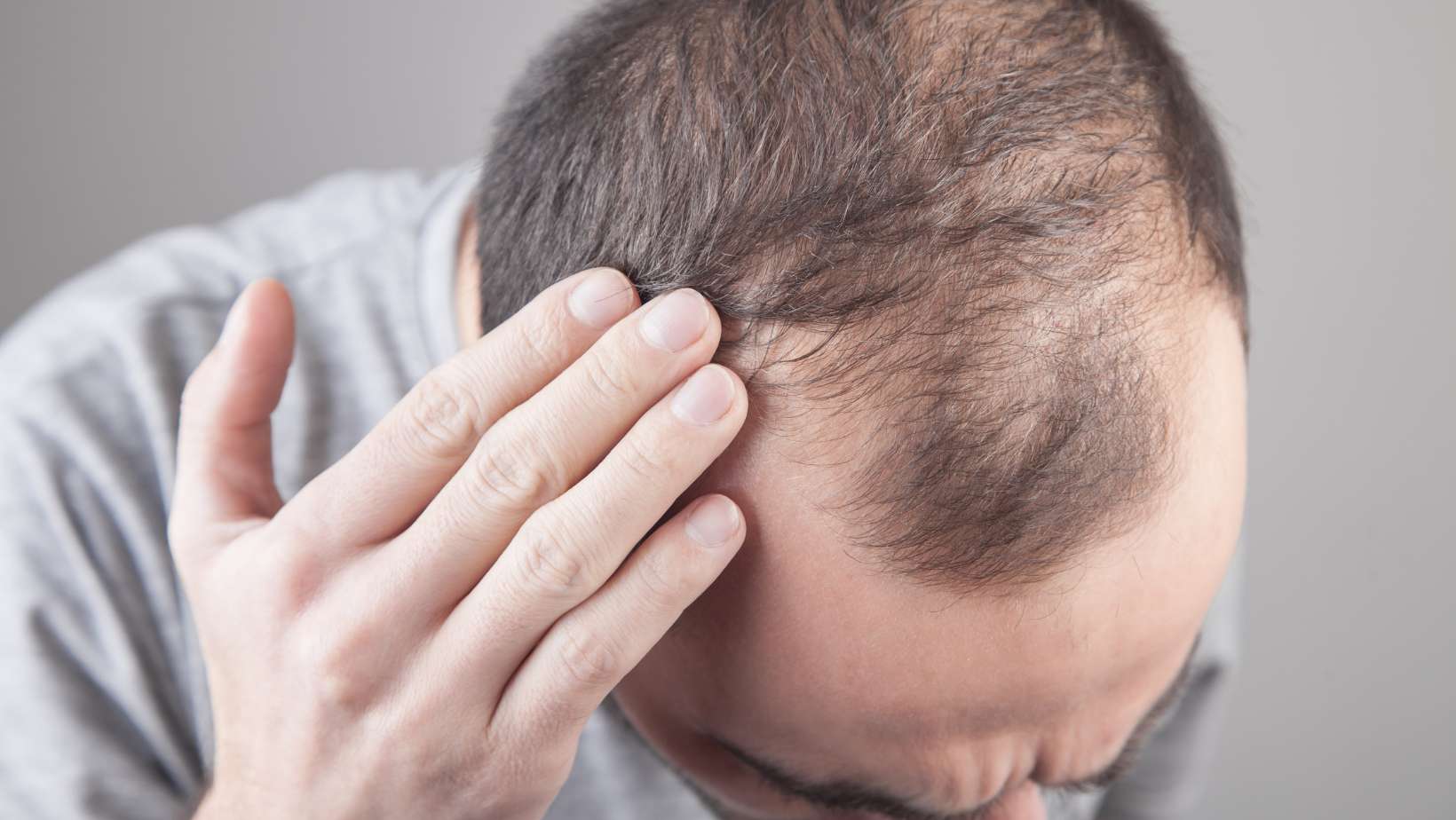 Caucasian man checking his hair. Hair loss problem