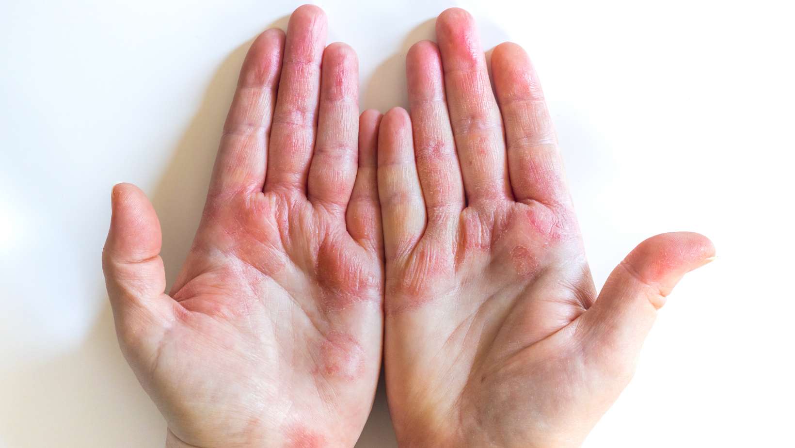 Strong allergic eczema on hands. Red, cracked skin with blisters